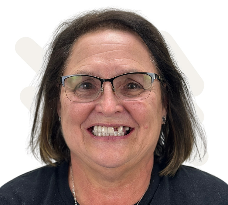 Betty Before Dental Implant
