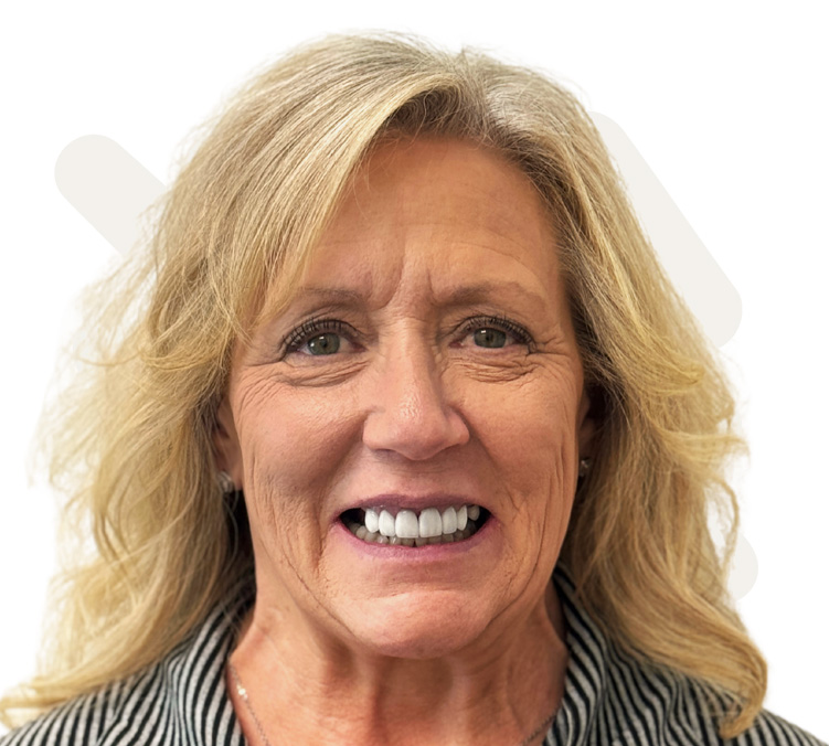 Holly Before Dental Implant