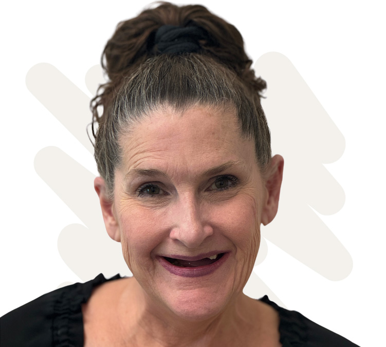 Jamie Before Dental Implant