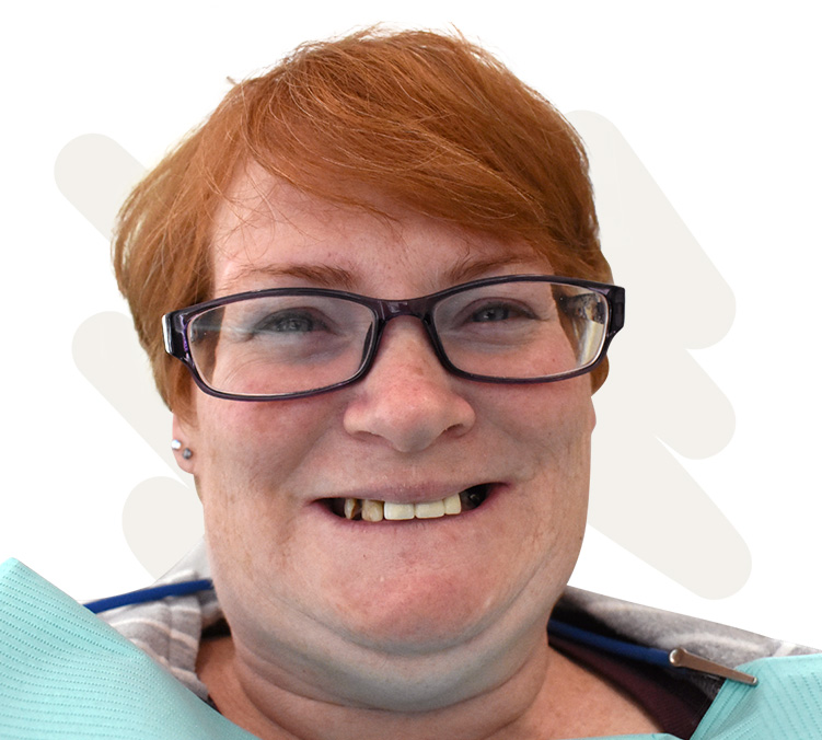 Jamie Before Dental Implant