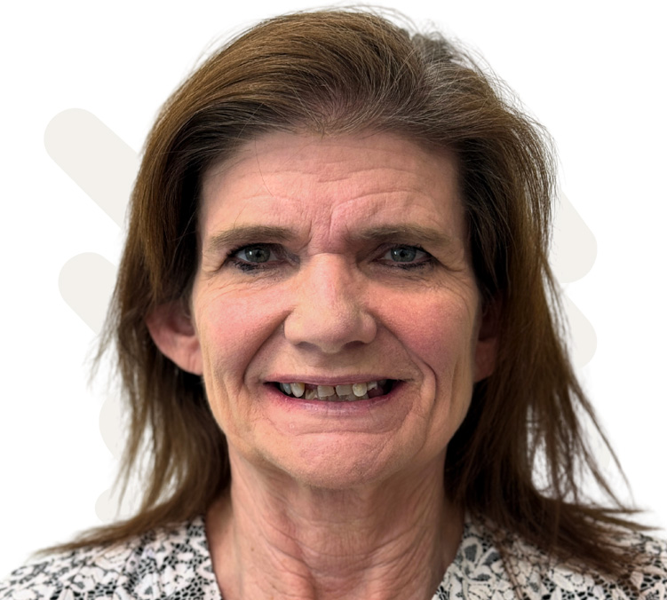 Janie Before Dental Implant