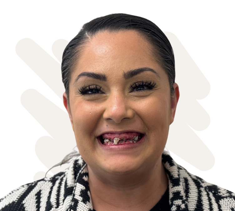 Priscilla Before Dental Implant