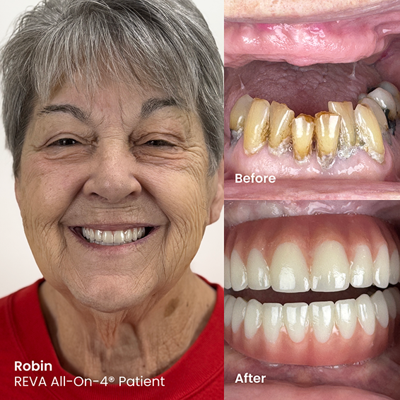 Before and After Image of a REVA Dental Implant Patient