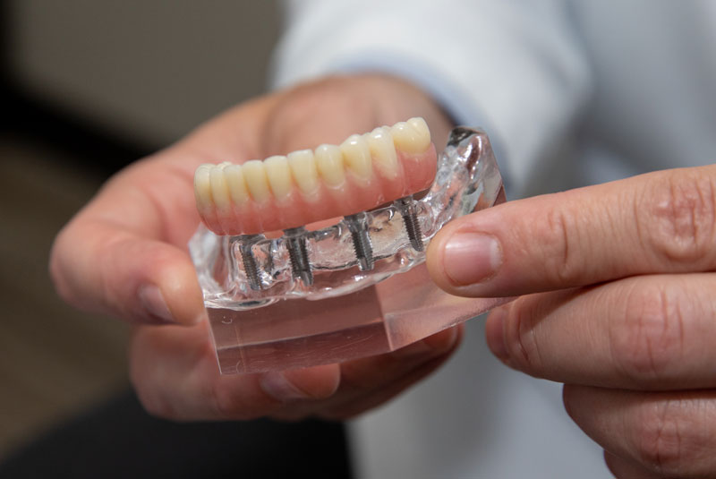 dentist explaining all on 4 dental implant options