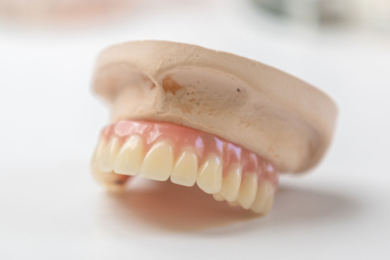 dental implant model in upper jaw placed on counter